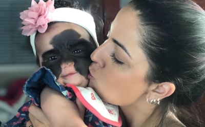 Маленькую американку с родимым пятном в виде «маски Бэтмена» вылечат в России