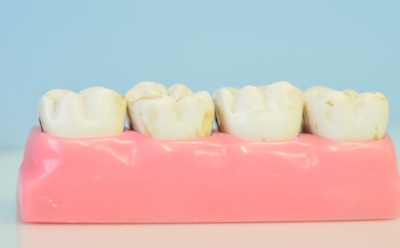Ученые придумали альтернативу зубным имплантатам