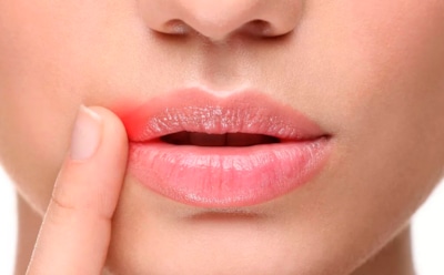 «Заеды» в уголках рта: причины и лечение