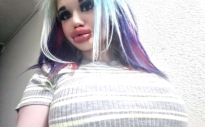 Болгарской студентке сделали 20 операций по увеличению губ