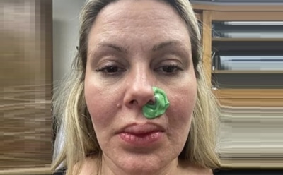 У певицы отвалилась ноздря из-за неудачной инъекции красоты