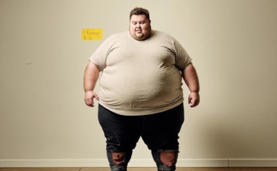 Ожирение и его скрытая угроза: как избыточный вес приводит к циррозу печени — советы врачей по предотвращению серьезных последствий