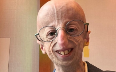 Прожил с прогерией дольше всех: Сэмми Бассо умер в 28 лет и стал символом борьбы с редкой болезнью