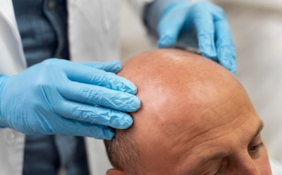 Генетическая связь облысения и болезней щитовидной железы: открытие китайских ученых — новая гипотеза для лечения