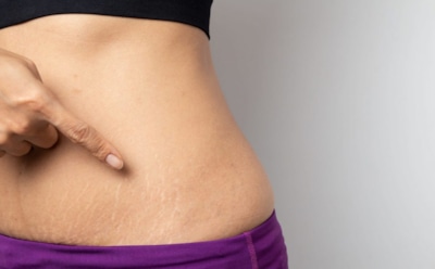 Как избежать растяжек: контроль веса, питание и уход за кожей — советы для здоровья и красоты