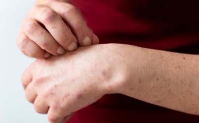 Загрязнение воздуха и экзема: новое исследование о влиянии экологии на здоровье кожи — данные от ученых