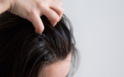 Уходи, перхоть: народные средства решения проблемы — простые способы избавления от недуга