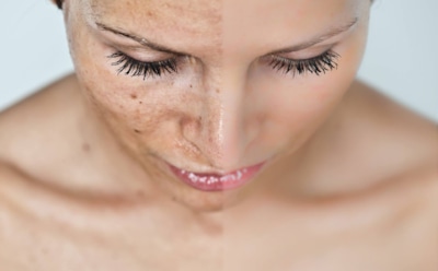 Пигментные пятна и питание: продукты для сияющей кожи — как вернуть ровный тон