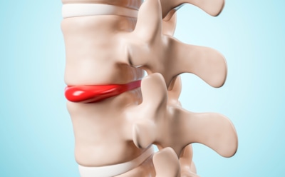 Грыжа — болезнь профессий: хирург назвал группы риска — кому стоит быть осторожнее