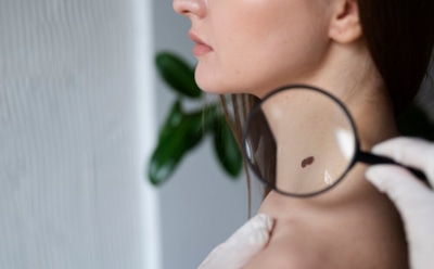 Когда родинка становится опасной: 5 тревожных признаков — что важно знать о рисках