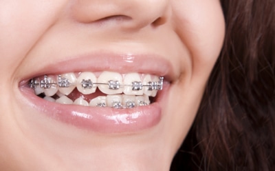 Сомнительная экономия: опасные последствия покупки брекетов на маркетплейсах — риск для зубов и здоровья