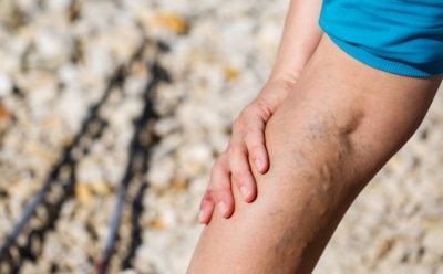 Варикоз и образ жизни: факторы риска для вен — врач объяснил, как избежать проблемы