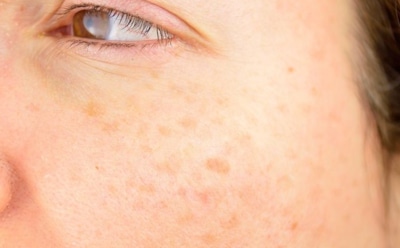 Весенний уход за кожей: как предотвратить появление пигментных пятен — советы дерматолога