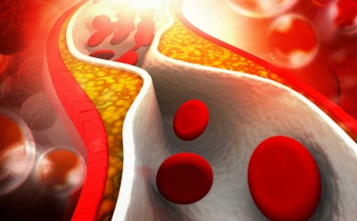 Как снизить уровень холестерина: советы кардиолога — диета, спорт и лекарства