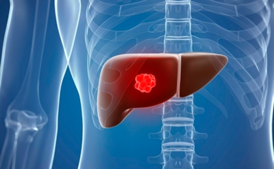 Рак печени: как распознать ранние признаки — стадии, диагностика и современные методы лечения