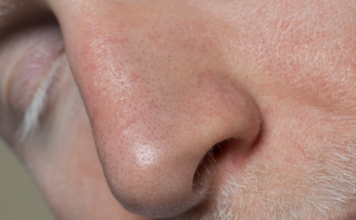 Проблема в носу, а страдает весь организм: искривление перегородки становится причиной болезней — не откладывайте визит к врачу