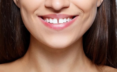 Не просто щель между зубами: стало известно, чем опасна диастема у взрослых — врач раскрыл шокирующие последствия