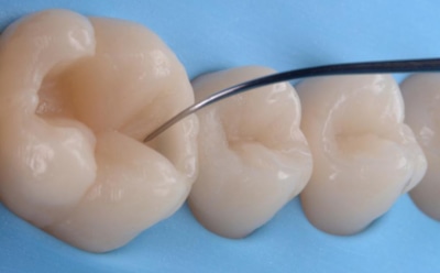 Маленькая трещина — большие проблемы: врач рассказал, какие риски несет дефект пломбы