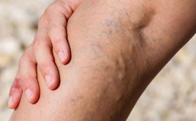 Варикоз — лишь вершина айсберга: врач рассказал, чем опасна венозная недостаточность, если ее не лечить