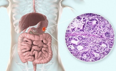 Вы не заметили — но рак уже тут: врач назвал неочевидные признаки патологии