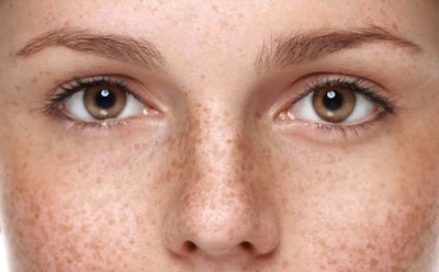 Когда загар оборачивается пятнами: врач рассказала, как солнце провоцирует пигментацию