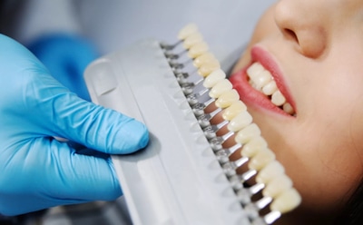 Белоснежная улыбка с риском для эмали: стоматолог предупредила об опасности домашних методов отбеливания