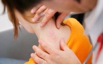 Не просто сыпь: дерматолог рассказала, что на самом деле вызывает псориаз