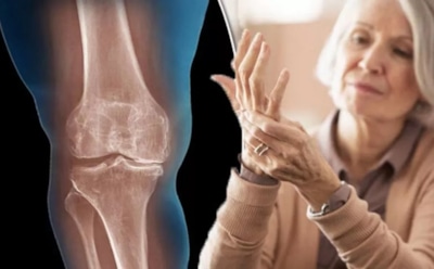 Переломы начинаются задолго до падений: доктор Мясников назвал симптомы остеопороза, которые легко пропустить