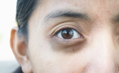 Темные круги под глазами — не всегда от усталости: что на самом деле портит взгляд