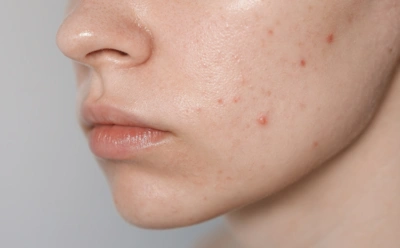 Замучило акне — откажитесь от этой еды: какие продукты чаще всего усугубляют воспаление