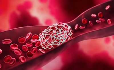 Когда говорят «оторвался тромб»: вот что на самом деле происходит в этот момент в организме