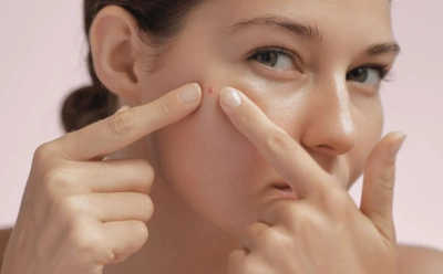 Давите прыщи — вы пожалеете об этом: почему акне возвращается и что нужно делать