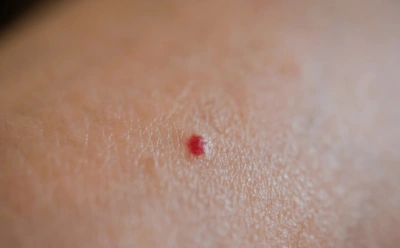 Сорвали родинку — не паникуйте: когда это действительно опасно и когда — лишь повод задуматься