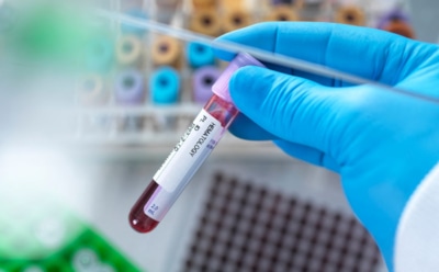 Как лечение анемии бьет по печени: цена, которую платит организм за борьбу с дефицитом железа