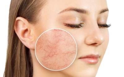 Когда покраснение щек — не безобидный румянец: что провоцирует купероз и как сгладить ситуацию