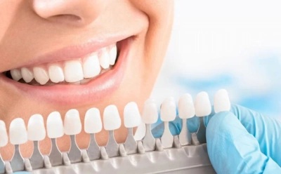 Почему так много мифов об отбеливании зубов: разрушает ли процедура эмаль и стоит ли ее бояться