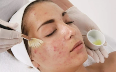 Жирная кожа требует особого подхода: эти процедуры применяют для контроля себума и пор