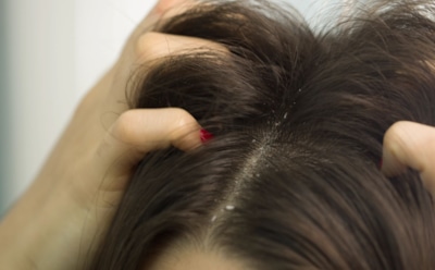 Если перхоть возвращается снова и снова: какие скрытые дефициты провоцируют проблему