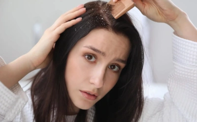 Голова постоянно в белых хлопьях перхоти: эти средства действительно лечат, а не маскируют проблему