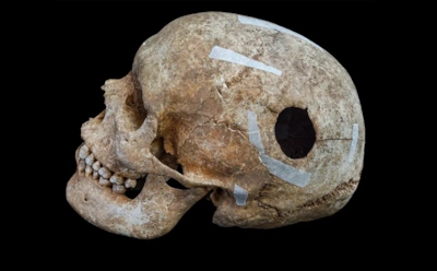 Всех удивил его рост: в братской могиле парка нашли «гиганта» со следами древней трепанации