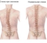 Как лечить искривление позвоночника
