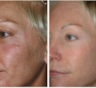 Фракционный лазерный термолиз – идеальный способ омоложения