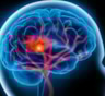 "Рассеянный склероз": медики узнали, кто рискует заболеть страшным недугом