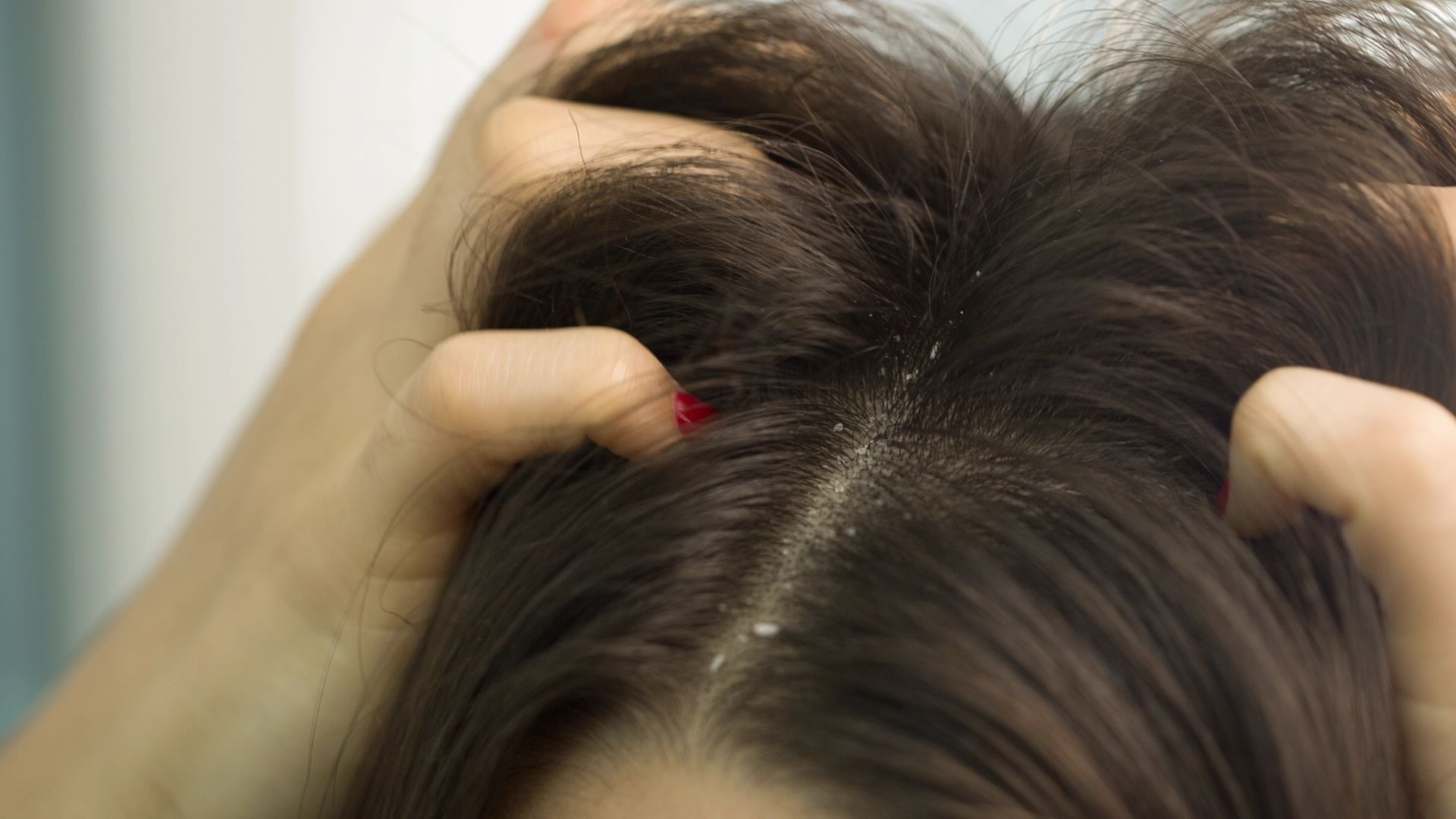 Если перхоть возвращается снова и снова: какие скрытые дефициты провоцируют проблему