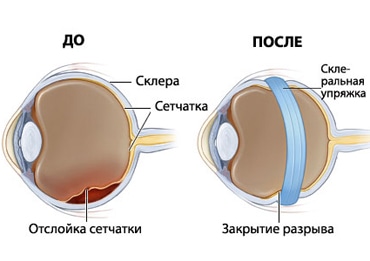 Методы лечения отслойки сетчатки глаза Методы лечения отслойки сетчатки глаза