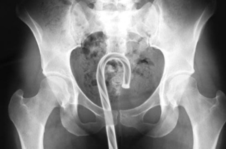 Рентгеновский снимок Рентгеновский снимок