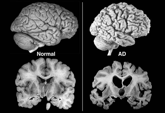 Здоровый мозг и мозг при болезни Альцгеймера