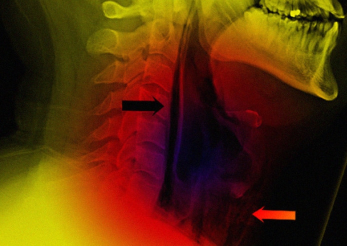 Британец чихнул и порвал глотку Британец чихнул и порвал глотку