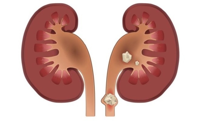 Ученые выяснили, от каких продуктов появляются камни в почках
