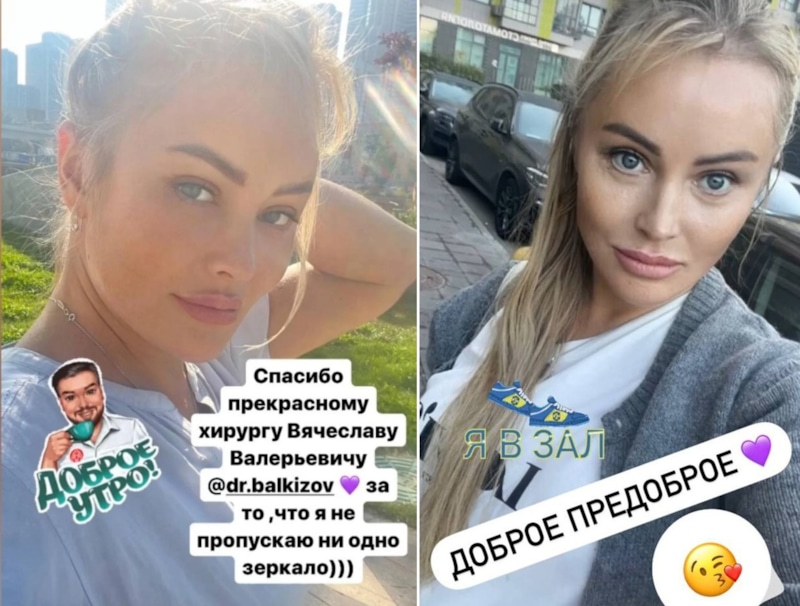 Дана Борисова показала лицо через месяц после пластики
